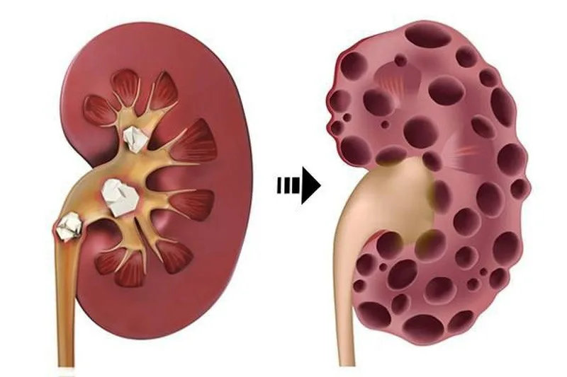 Dấu hiệu suy thận nữ