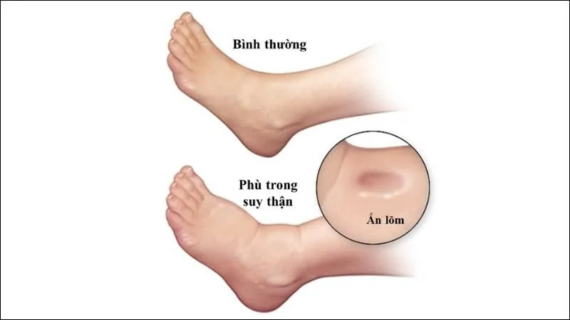 Dấu hiệu suy thận nữ