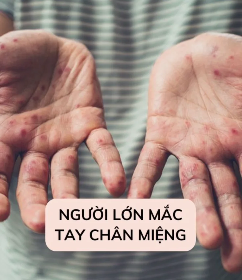 Người lớn vẫn có thể bị tay chân miệng, đặc biệt ở người thường xuyên tiếp xúc gần với trẻ đang mắc bệnh.