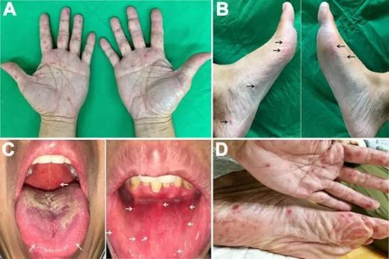 Người lớn mắc tay chân miệng có thể sốt, đau họng, loét miệng và nổi mụn nước tại lòng bàn tay hoặc lòng bàn chân.